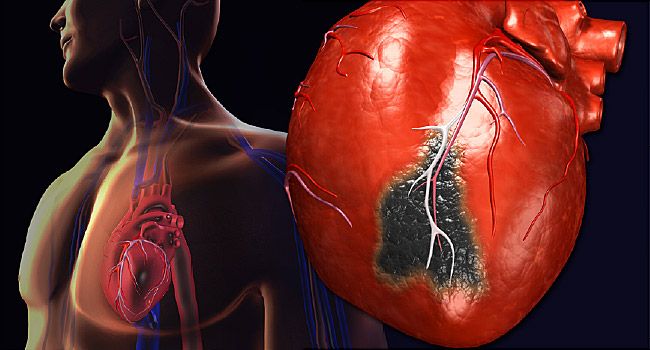 zawał serca
objawy zawału serca
przyczyny zawału serca
zawał ściany dolnej