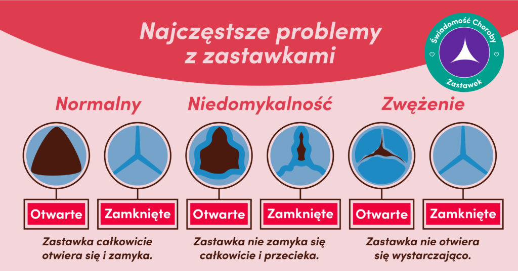 Choroba zastawki serca, wczesna diagnostyka, leczenie choroby serca, kampania świadomości, Serce na Banacha, Heart Valve Voice, Global Heart Hub, stetoskopowe badanie serca, objawy choroby serca, duszność, zawroty głowy, zmęczenie, edukacja pacjentów, świadomość społeczna, Tydzień Świadomości Choroby Zastawki Serca, regularne badania, szmer serca, leczenie operacyjne, farmakoterapia, organizacje pacjentów, zdrowie serca, echokardiogram, wydłużenie życia, poprawa jakości życia, objawy bezbolesne, inicjatywa globalna, prewencja chorób serca, wsparcie pacjentów, leczenie zastawki.